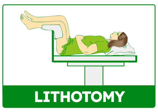 Lithotomy Position